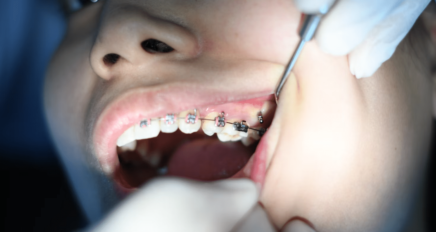 How Much Is It To Get A Tooth Capped