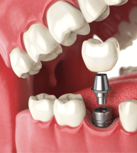 affordable dental implants blog