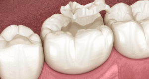 dental sealant vs filling