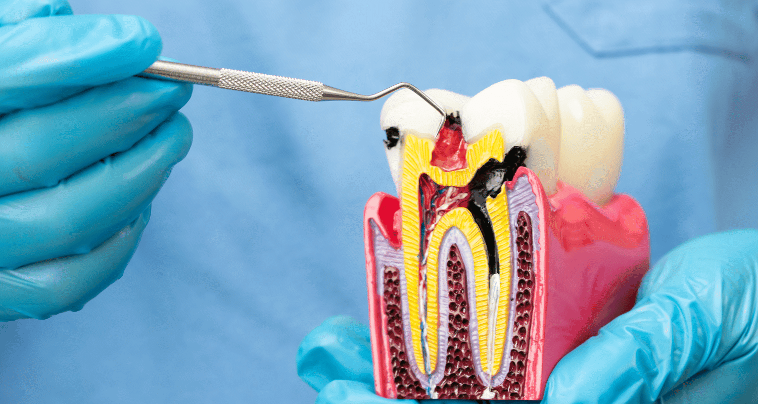 retratamiento de conducto radicular