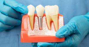 Root Canal Treatment Side Effects