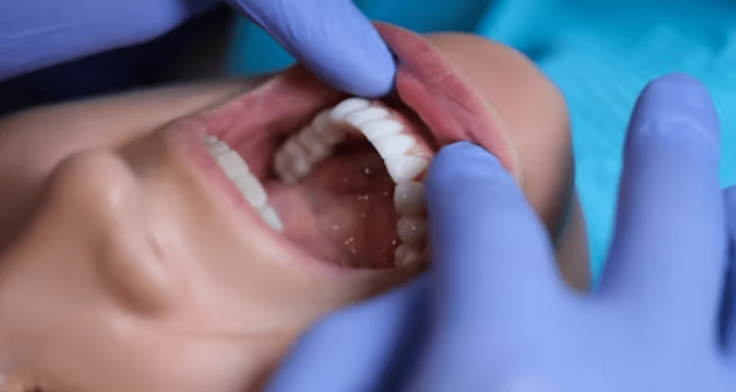 What Type of Dentist Does Root Canals