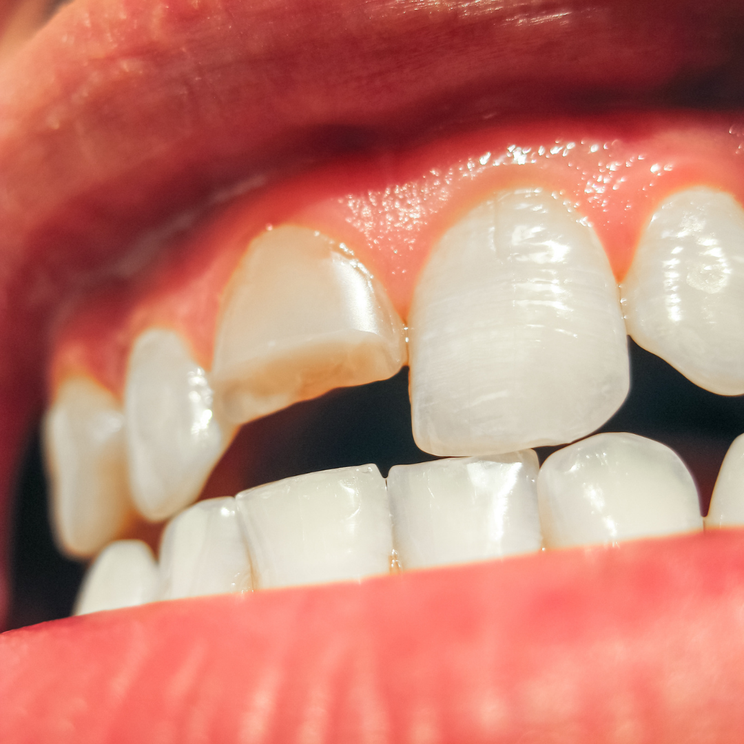 Cuidado de dientes rotos en Nashville