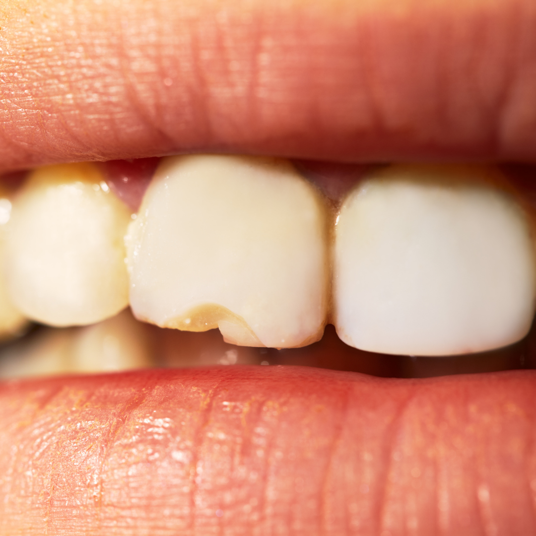 Tratamiento de dientes fracturados en Nashville
