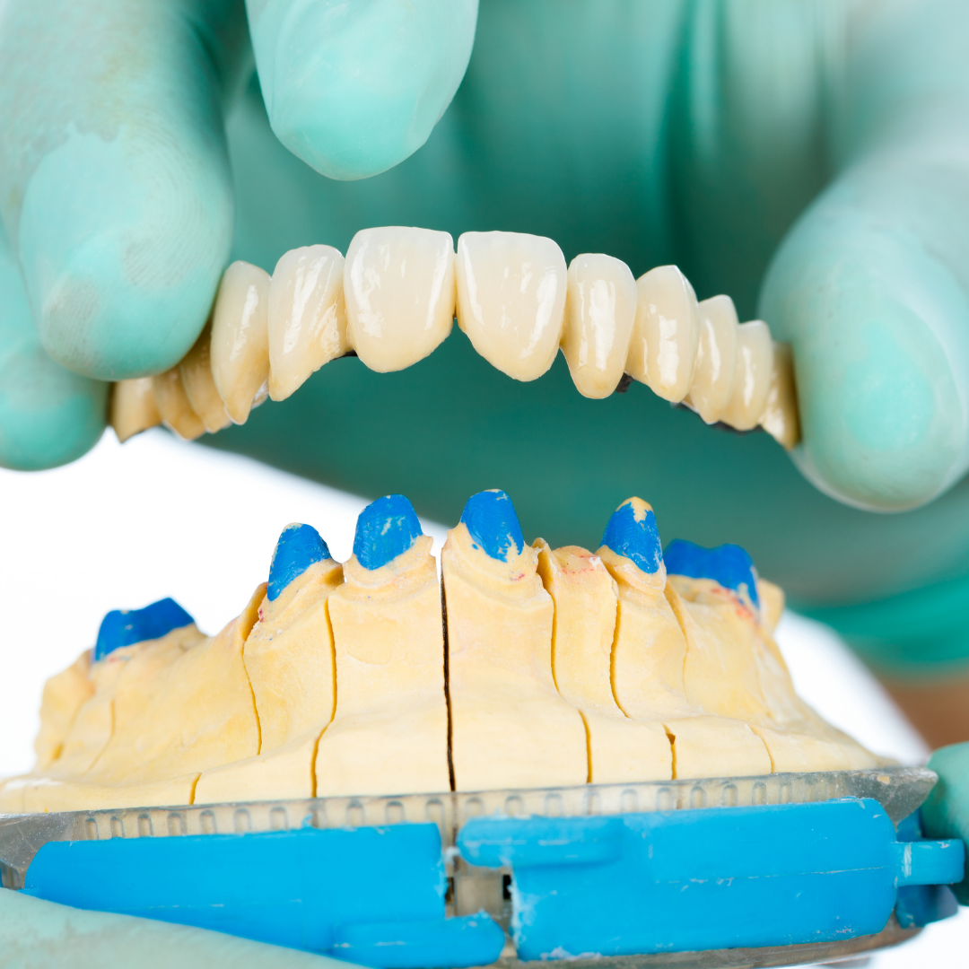 Dental Bridges in Nashville
