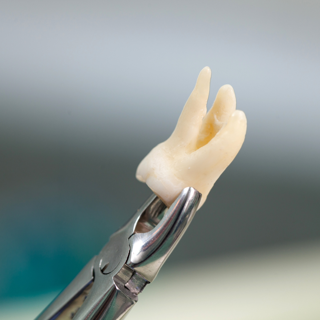 Dental Extractions Nashville