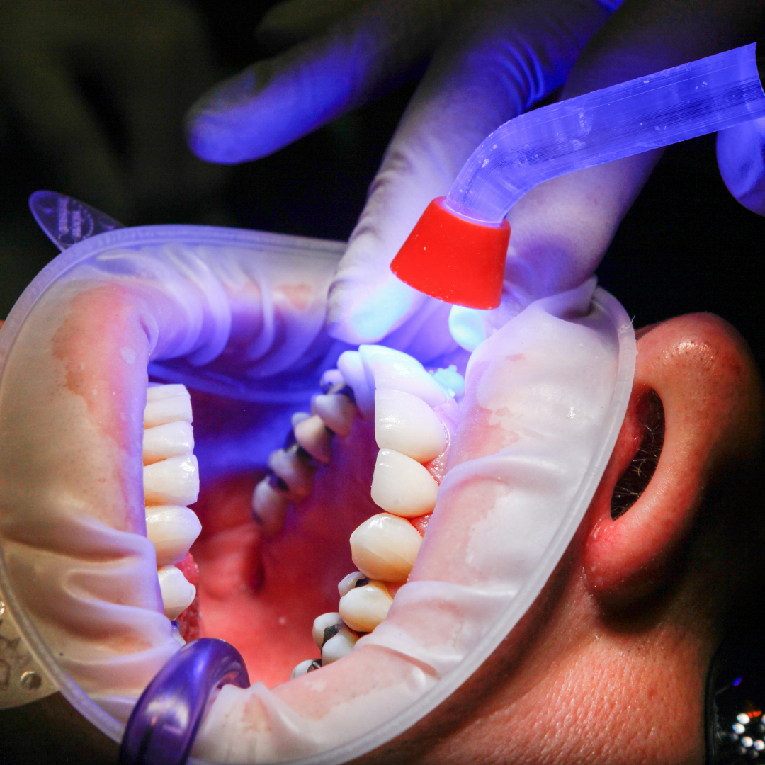 Empastes dentales en Nashville