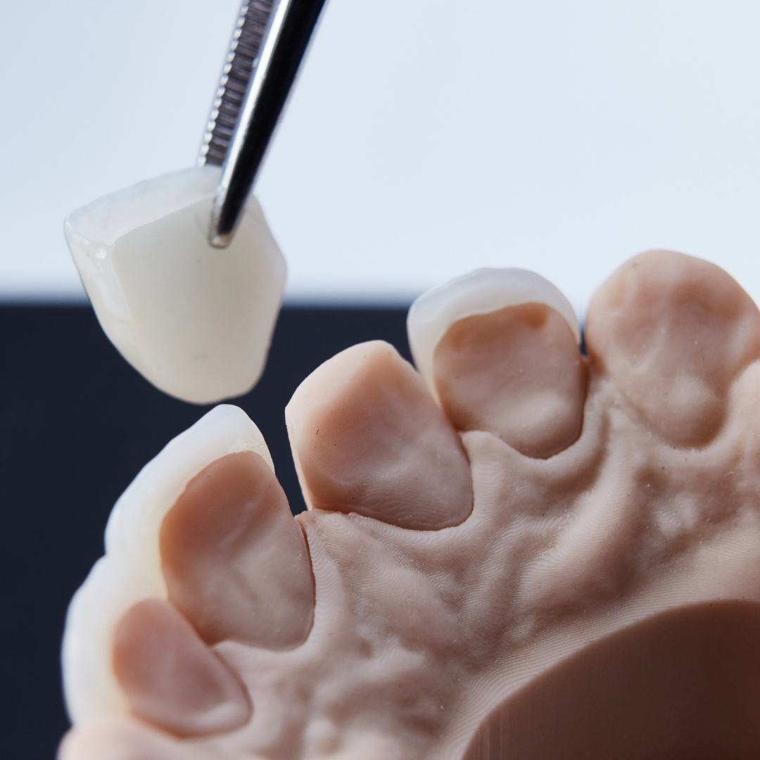 Dental Veneers Nashville