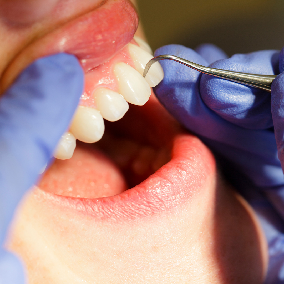 Limpieza dental en Nashville