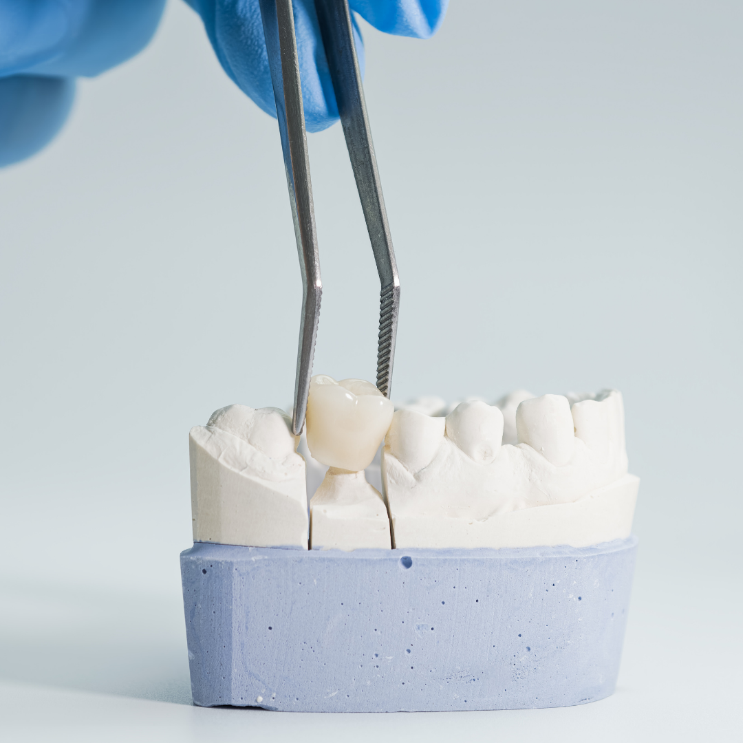 Nashville Dental Crown