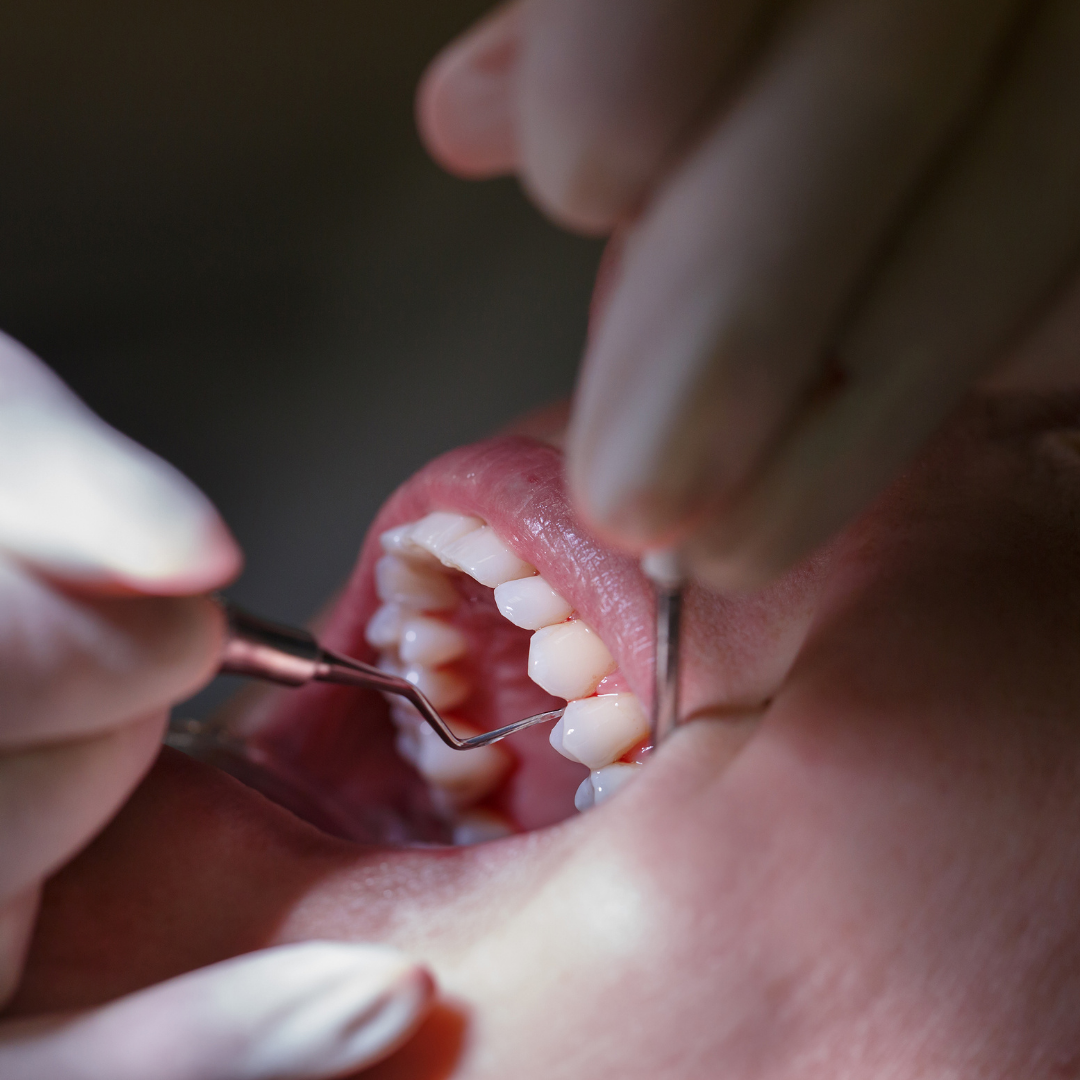 Periodontal Therapy in Nashville
