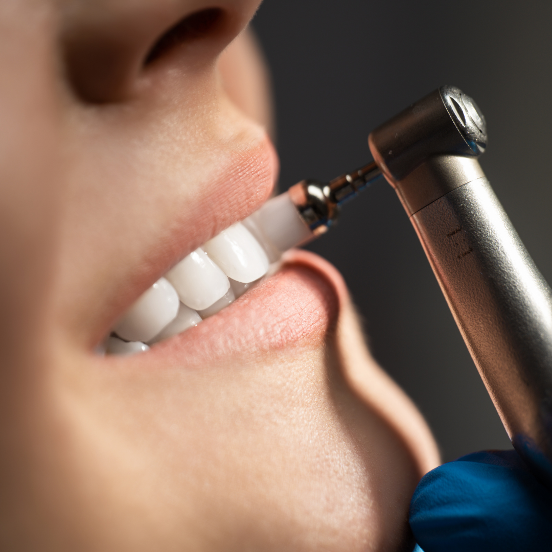 Teeth Whitening Nashville