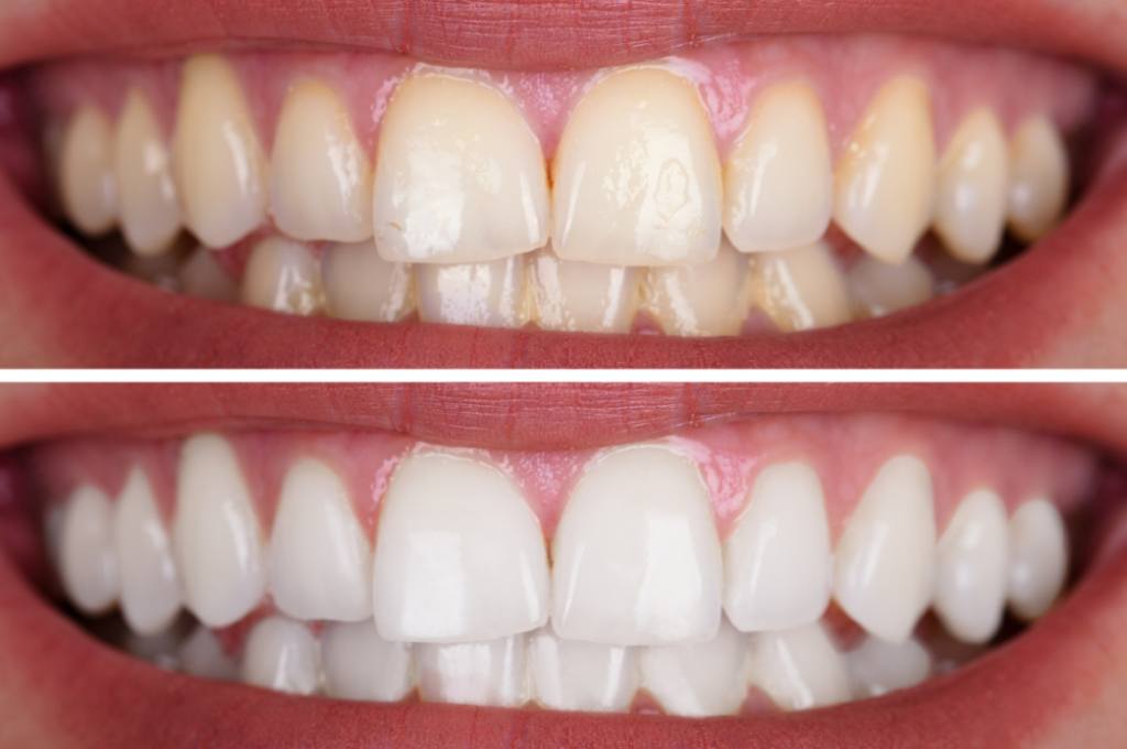 teeth whitening - dental faith