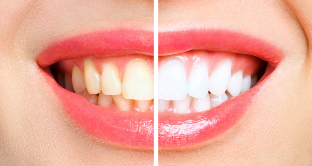 Hydrogen Peroxide Rinse vs. Whitening Strips