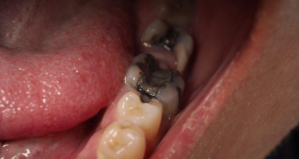 Exposed Tooth Roots in Nashville