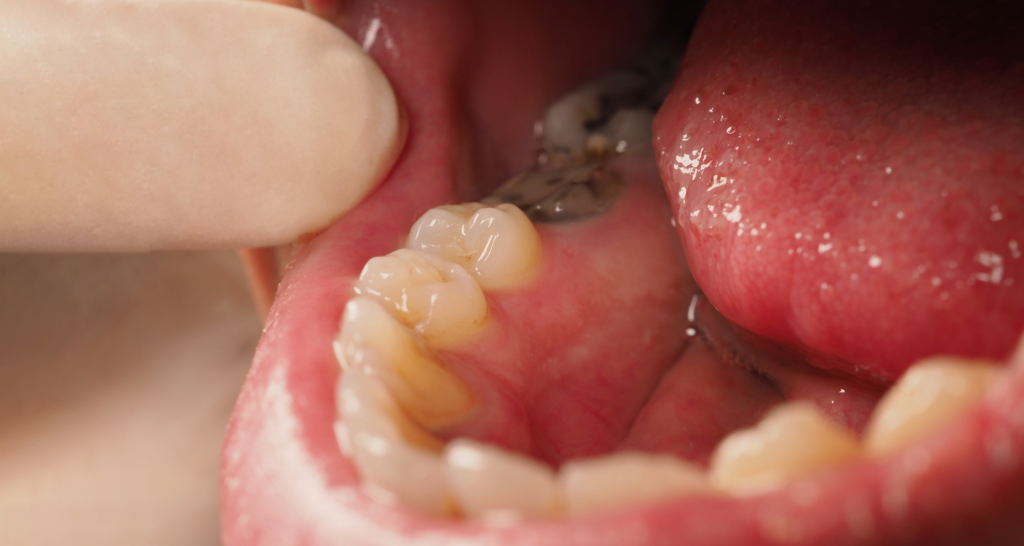 Exposed Tooth Roots in Nashville