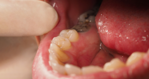 Exposed Tooth Roots in Nashville