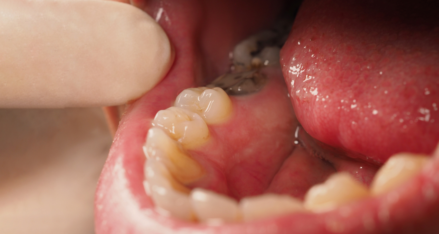 Exposed Tooth Roots in Nashville
