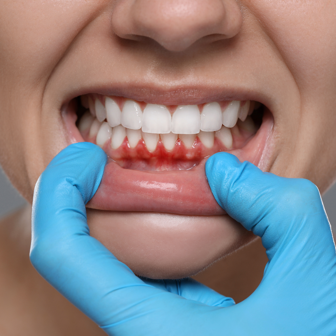 Nashville gum bleeding