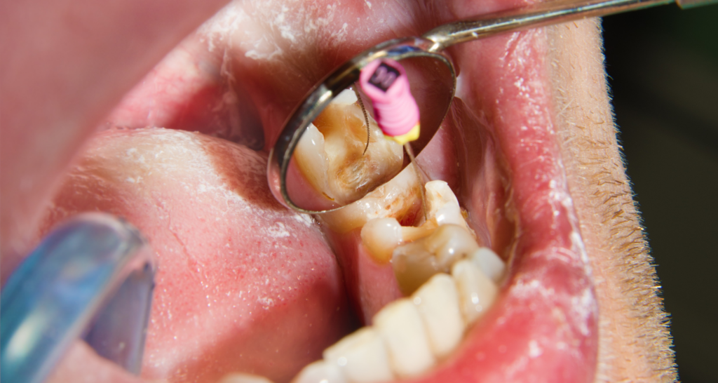 Signs Your Old Filling Needs to Be Replaced