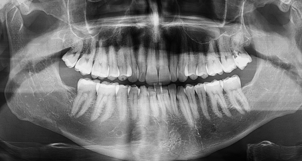 Are Dental X-Rays Safe