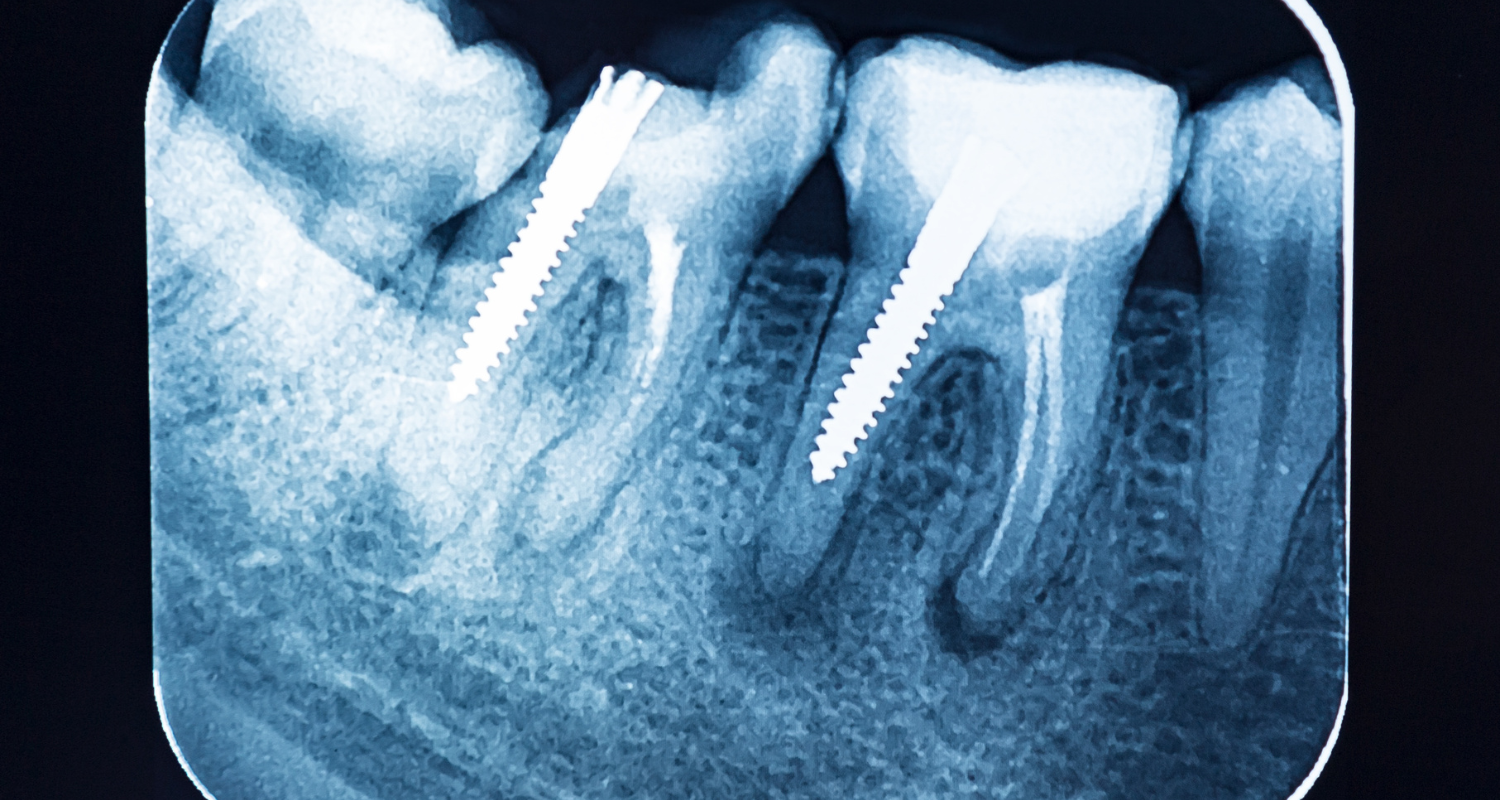 Are Dental X-Rays Safe