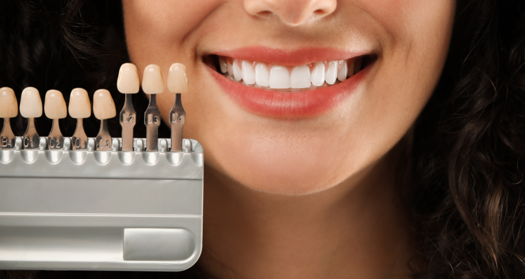 Teeth Bonding vs. Veneers in Nashville