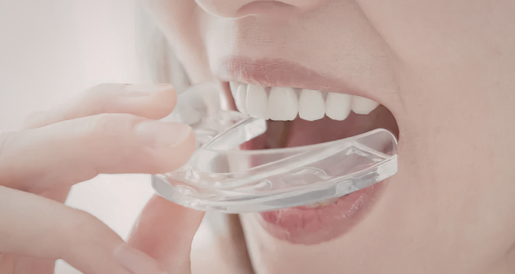 Mouthguards 101 in Nashville
