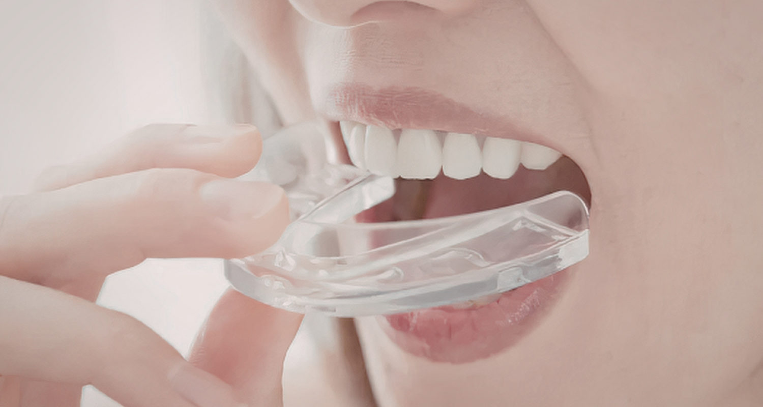 Mouthguards 101 in Nashville